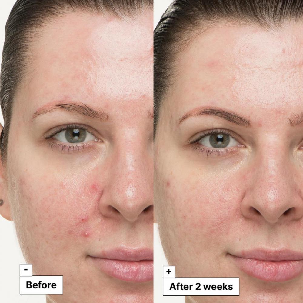Cicapair™ so soothing treatment
